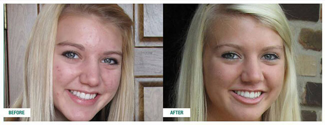 Sữa Rửa Mặt Trị Mụn Neutrogena Oil-Free Acne Wash xuất xứ Mỹ