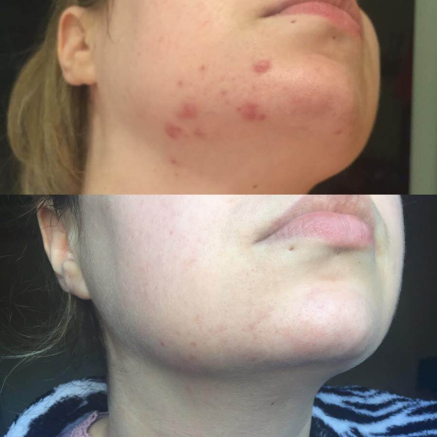 Làn da được cải thiện đáng kể sau 4 tuần sử dụng Tinh Chất Dưỡng Da Paula's Choice Clinical Treatment 1% Retinol Làn da được cải thiện đáng kể sau 4 tuần sử dụng Tinh Chất Dưỡng Da Paula's Choice Clinical Treatment 1% Retinol